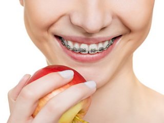 Тонкости исправления прикуса брекетами